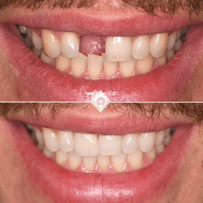 Before and After Carls Logo (2)