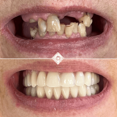 H. Spencer Before & After (2)