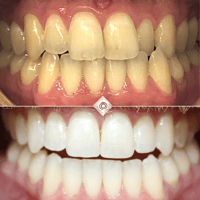 Whitening Before & After (1)